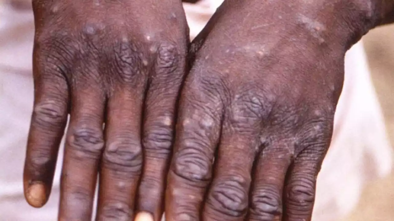 The WHO confirmed 92 monkeypox cases in 12 countries