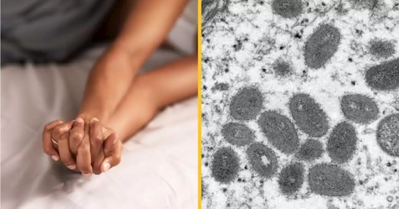 People with many sexual partners need to watch out for monkeypox, says chief doctor | JOE.ie