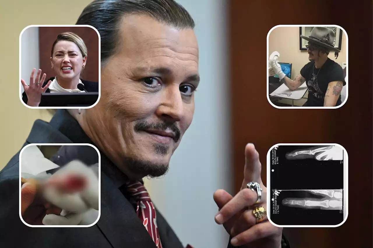 What happened to Johnny Depp's finger? Experts can't agree