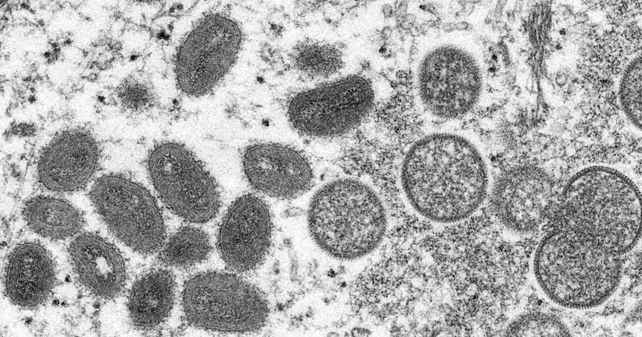 CDC investigating more monkeypox cases