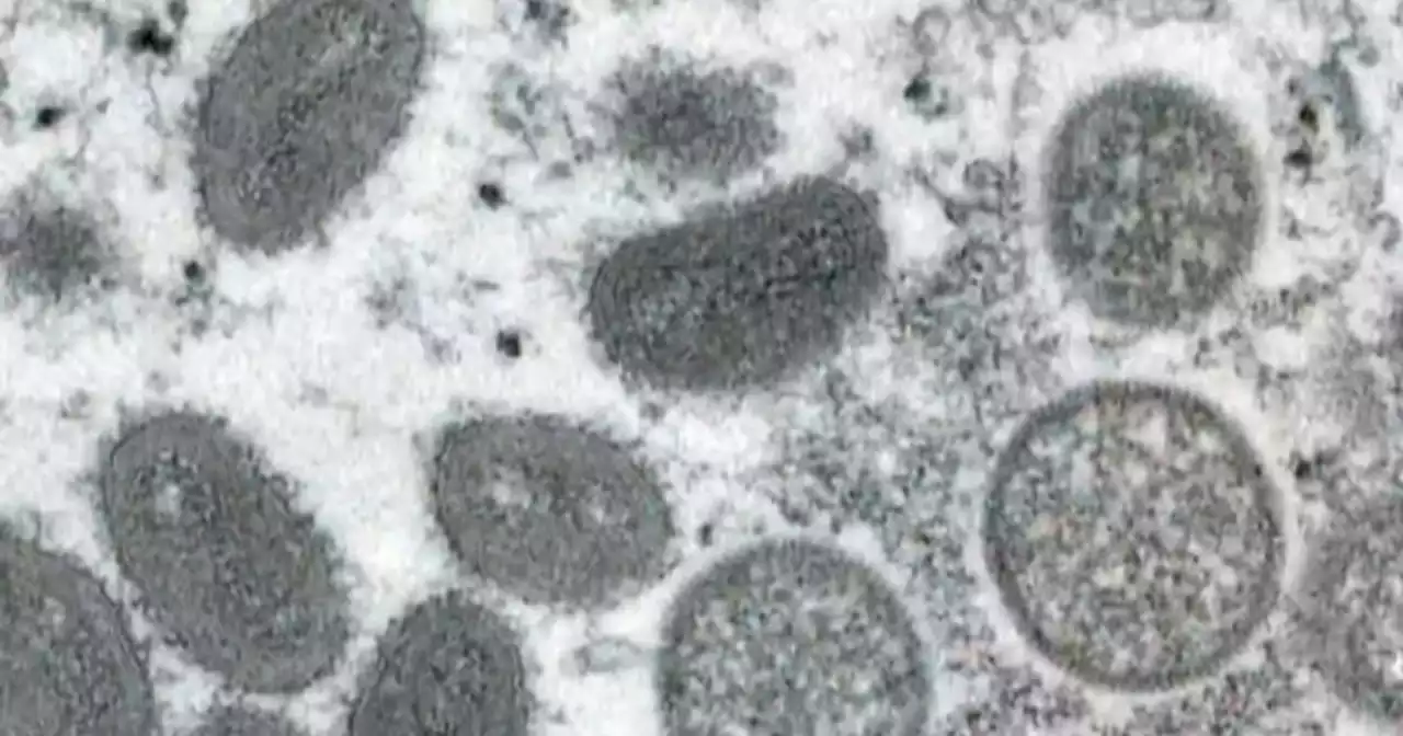 Officials investigating first possible case of monkeypox in California