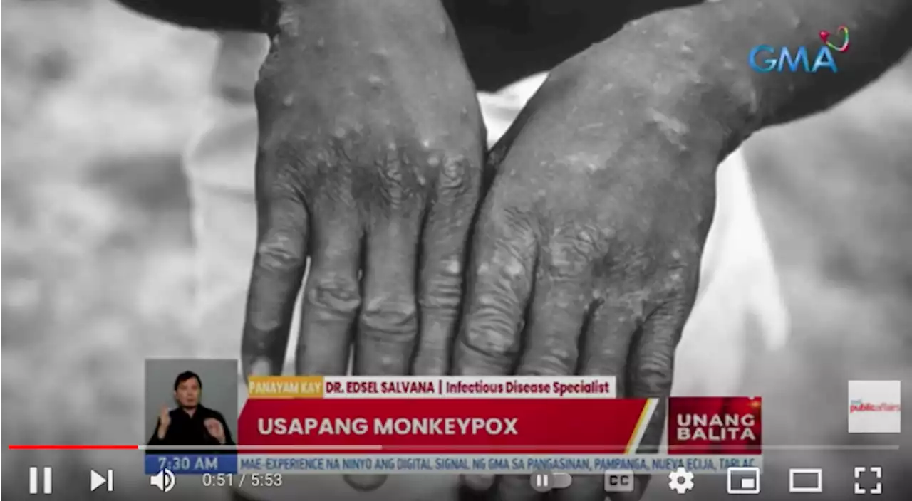 Monkeypox: What is it, how can you avoid it, and does it have a cure?