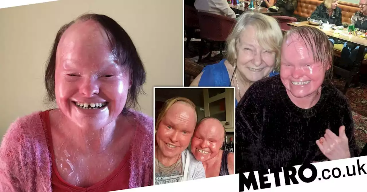 Woman whose skin grew too fast for her body dies aged 32