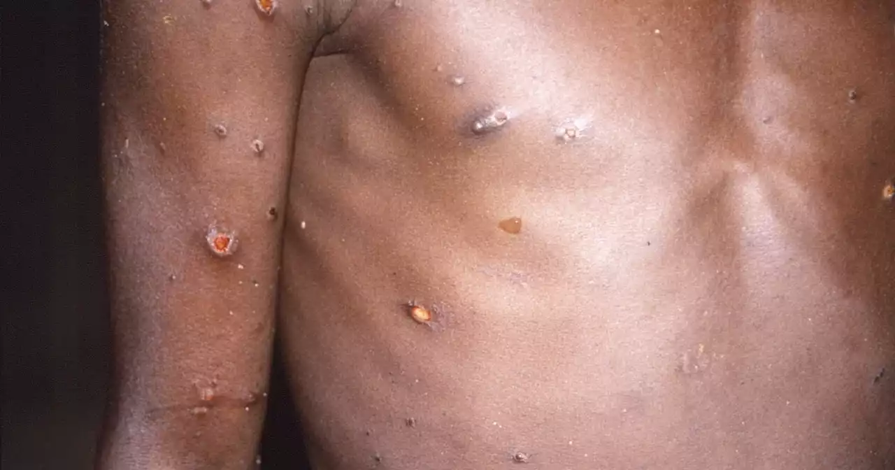 Lack of accessible monkeypox testing threatens response to outbreaks