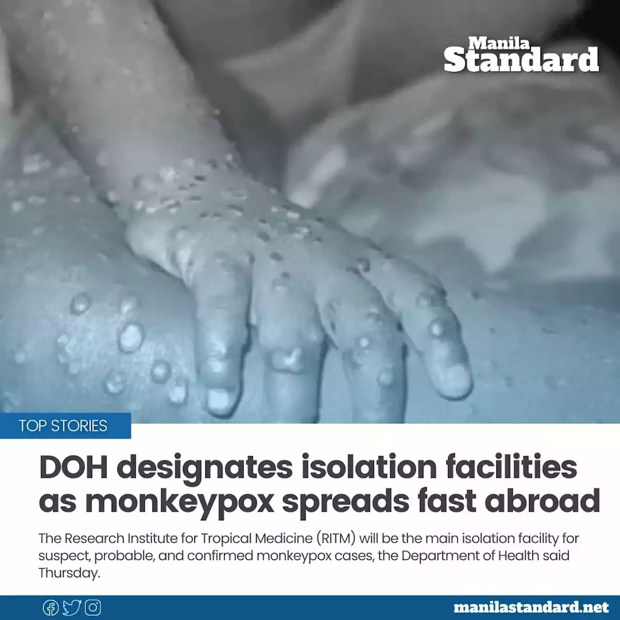 DOH designates isolation facilities as monkeypox spreads fast abroad