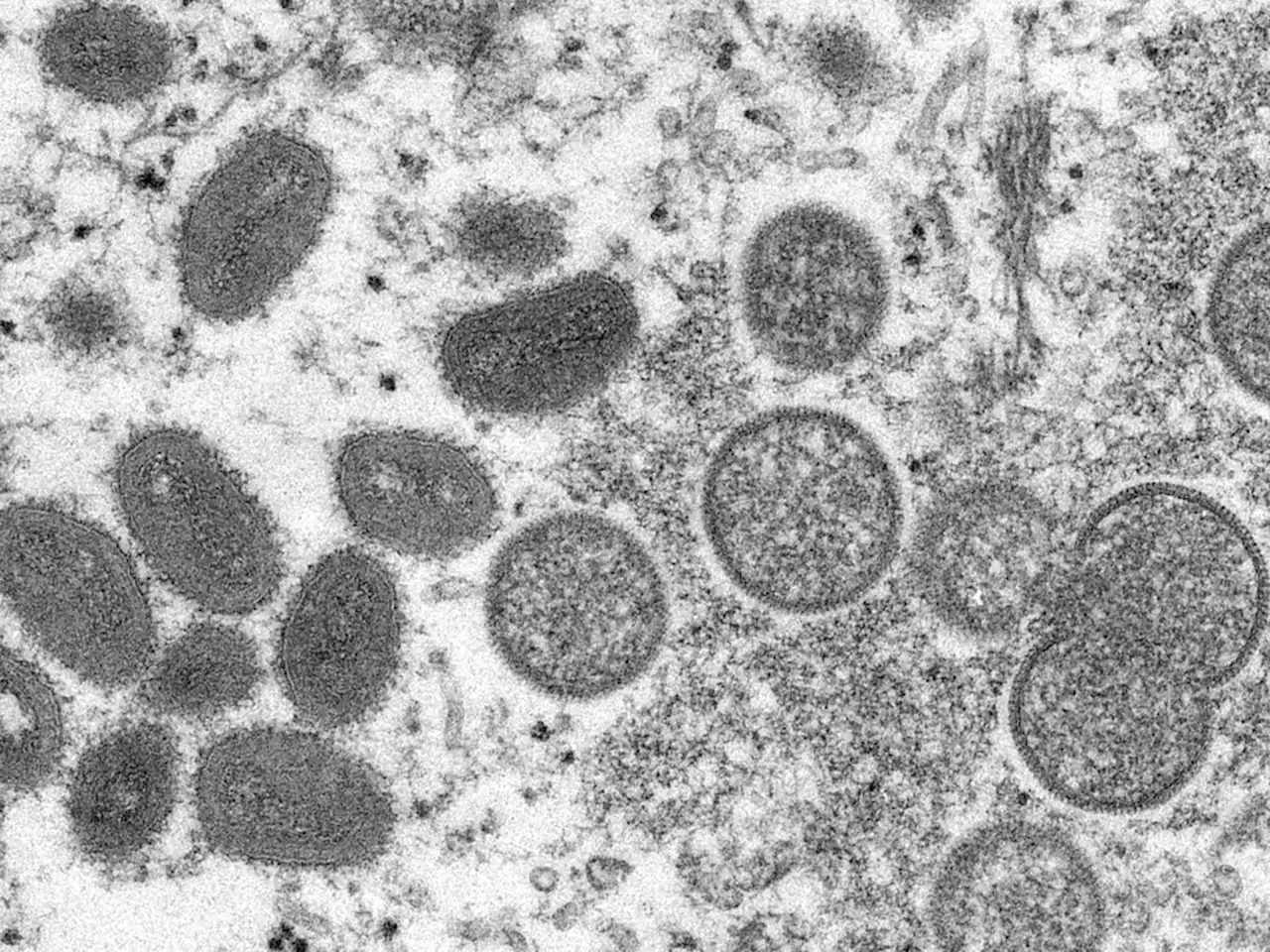 Jan Hajek, Victor Leung and Srinivas Murthy: Spread of monkeypox anywhere in the world puts us all at risk