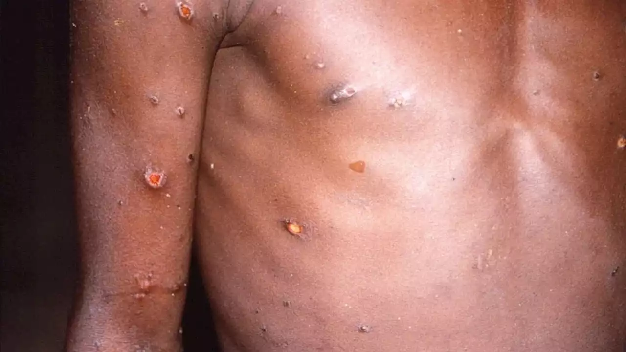 These are the symptoms of monkeypox and how to treat them