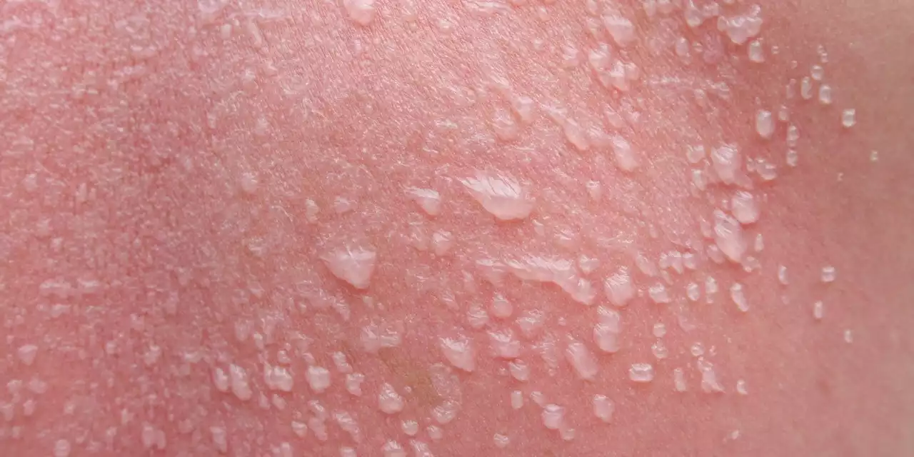 What to Do If You Get (Awful) Sunburn Blisters