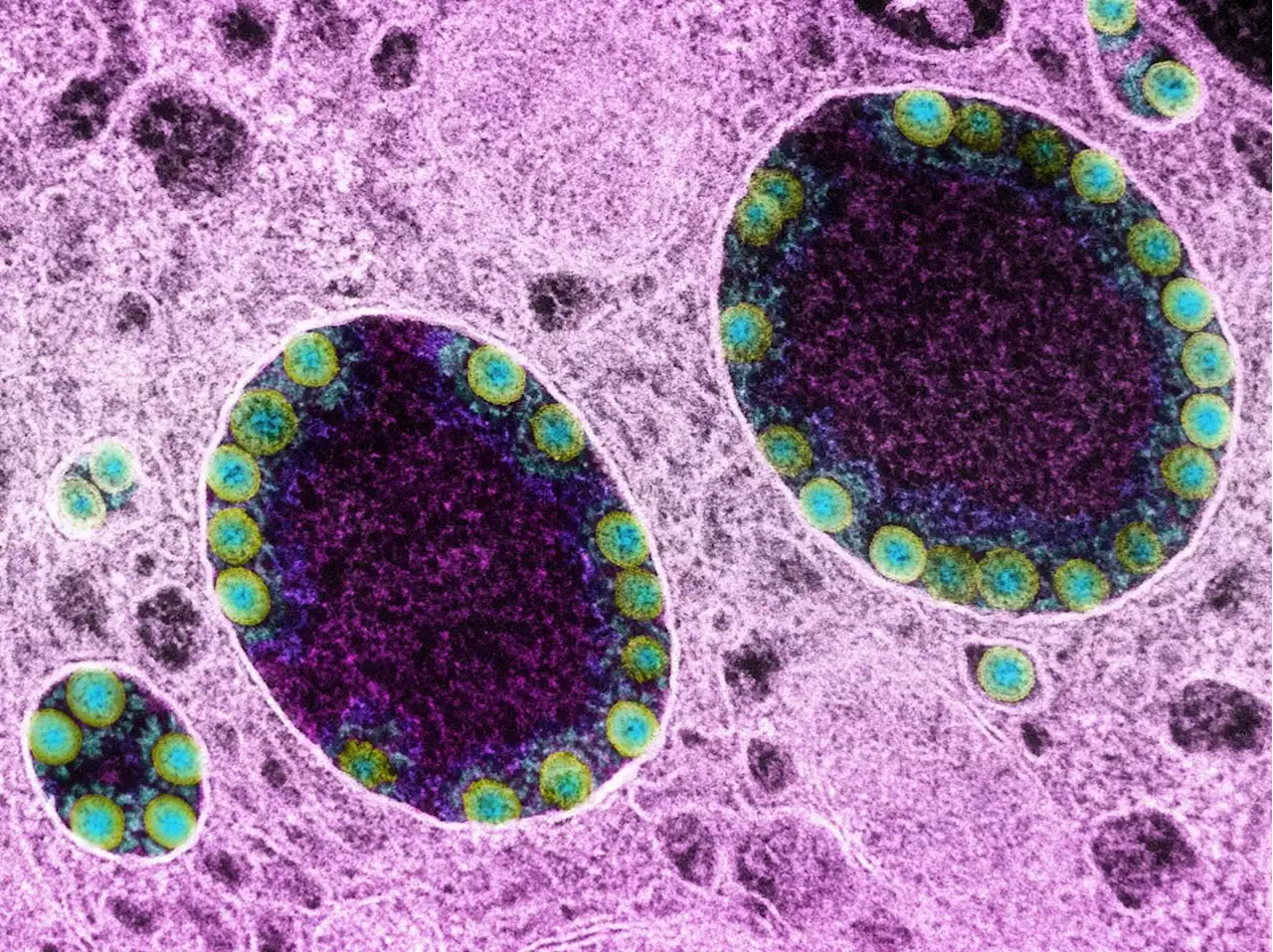 Covid Omicron Variant BA.2.12.1 Spreading Quickly Across United States; Related Cases Up Nearly 100% In Past Two Weeks