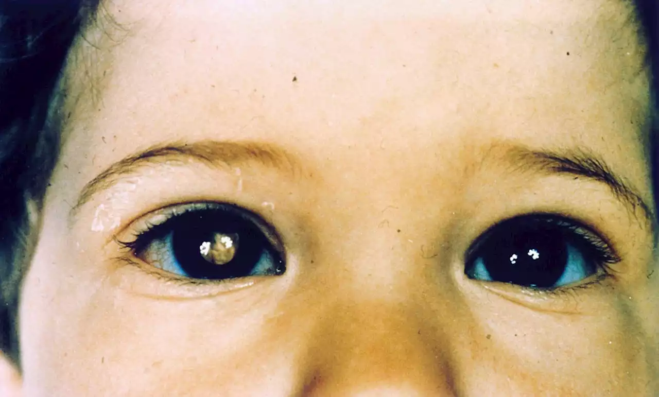 Test to spot rare eye cancer in unborn babies rolled out across NHS