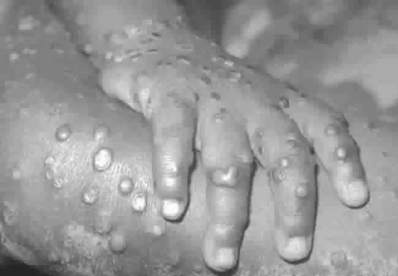 JUST IN: NCDC confirms 66 suspected monkeypox cases, one death