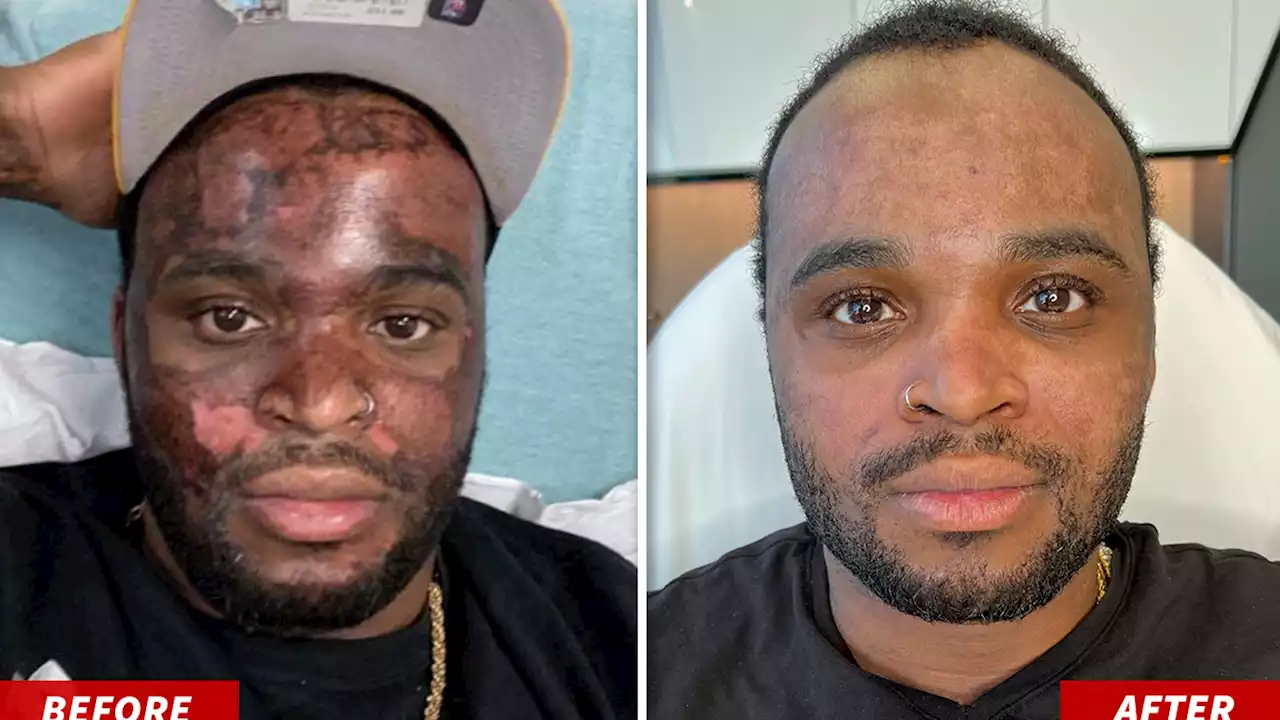 TikTok Chemical Peel Victim Gets Laser Treatments for Discoloration