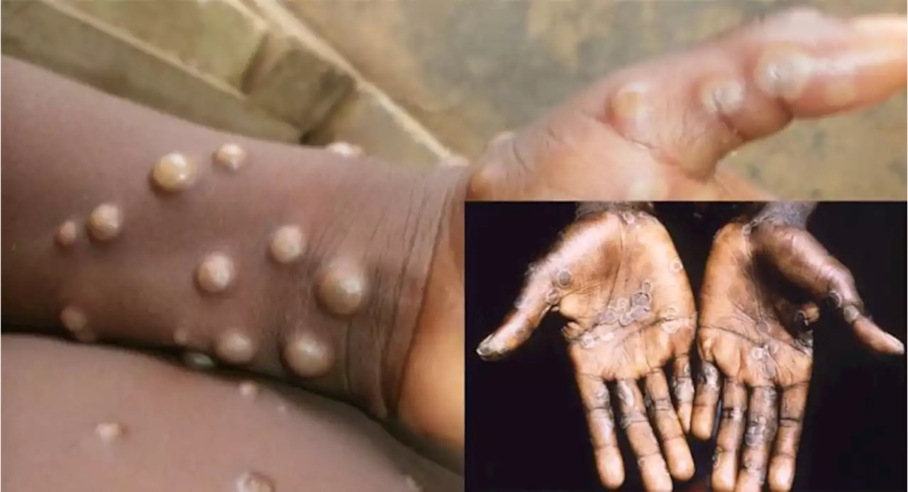 FG working with WHO, US agency, to curb monkeypox spread