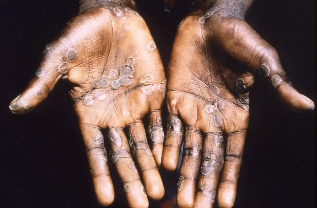 Everything WHO has said about monkeypox from pandemic fears to causes