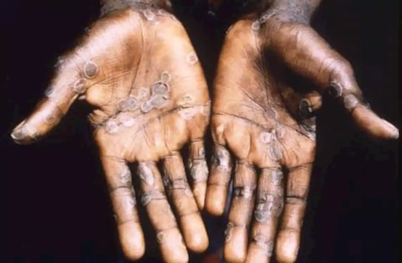 US Not Responsible For Monkeypox Outbreak In Nigeria, Has No Controlled Laboratories – Consulate General Reacts To Allegations Of Complicity | Sahara Reporters