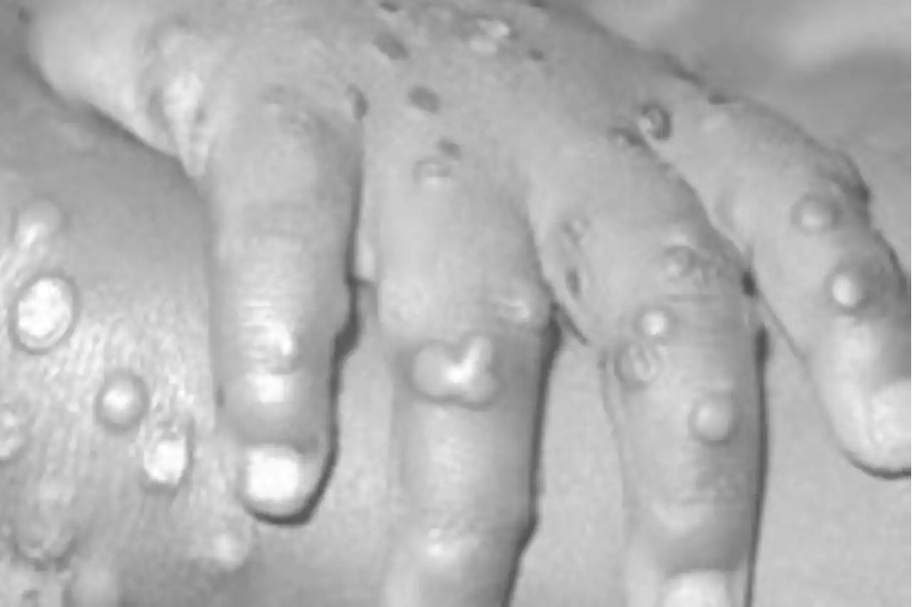 'Pure fabrication' — US debunks reports of monkeypox spread through labs in Nigeria