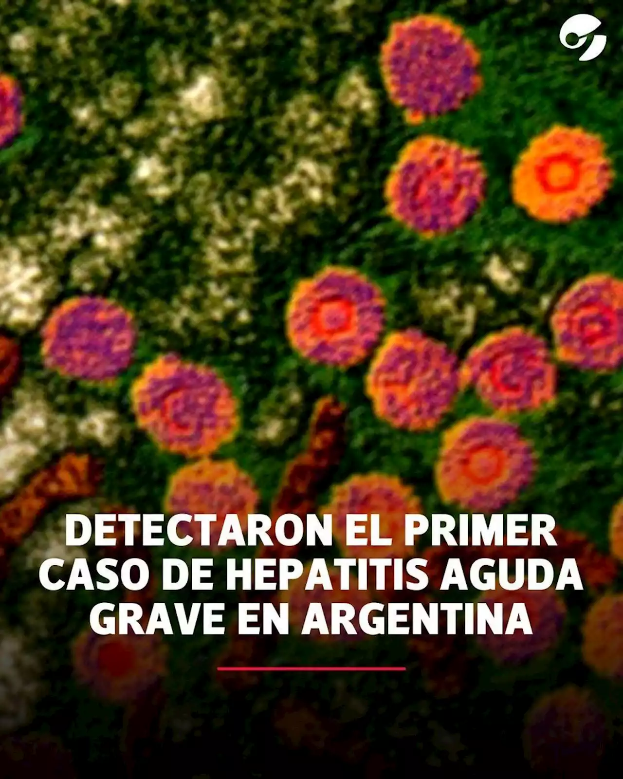 Primer caso en Argentina: qué es la hepatitis aguda grave en niños y cuáles son los síntomas