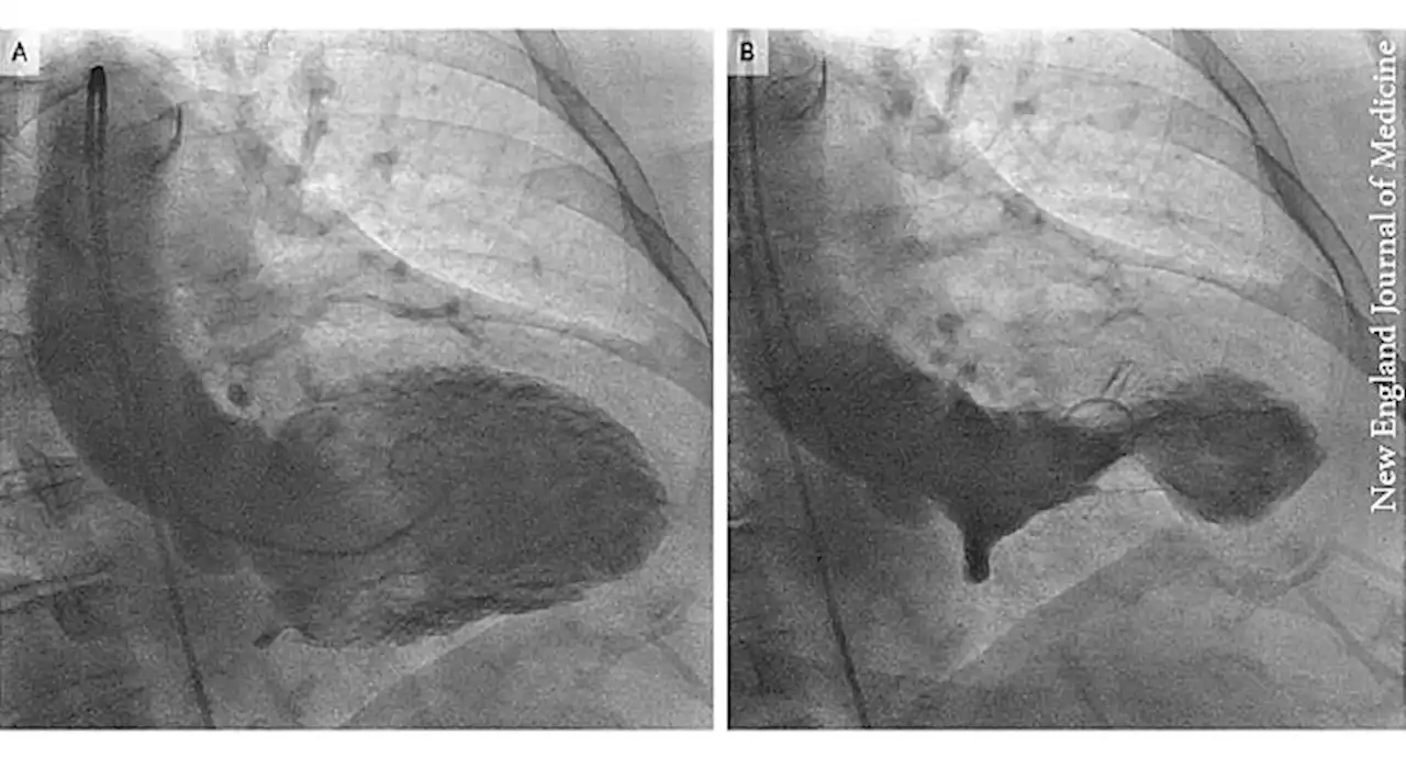 ‘Broken Heart Syndrome’ Also Linked to Happy Hearts