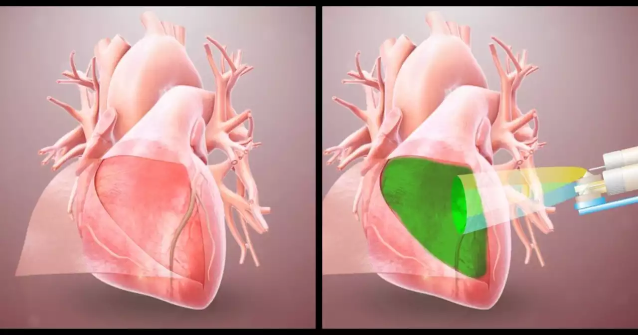 How to prevent the heart from sticking to other organs after surgery | KPBS Public Media