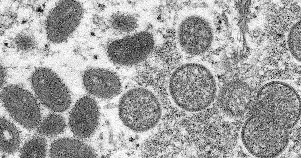 There are now 4 presumptive cases of monkeypox in New York City, health officials say