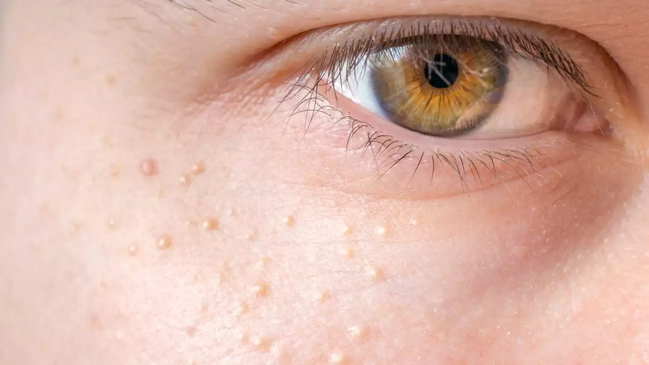 Those Tiny White Bumps on Your Face Aren't Acne