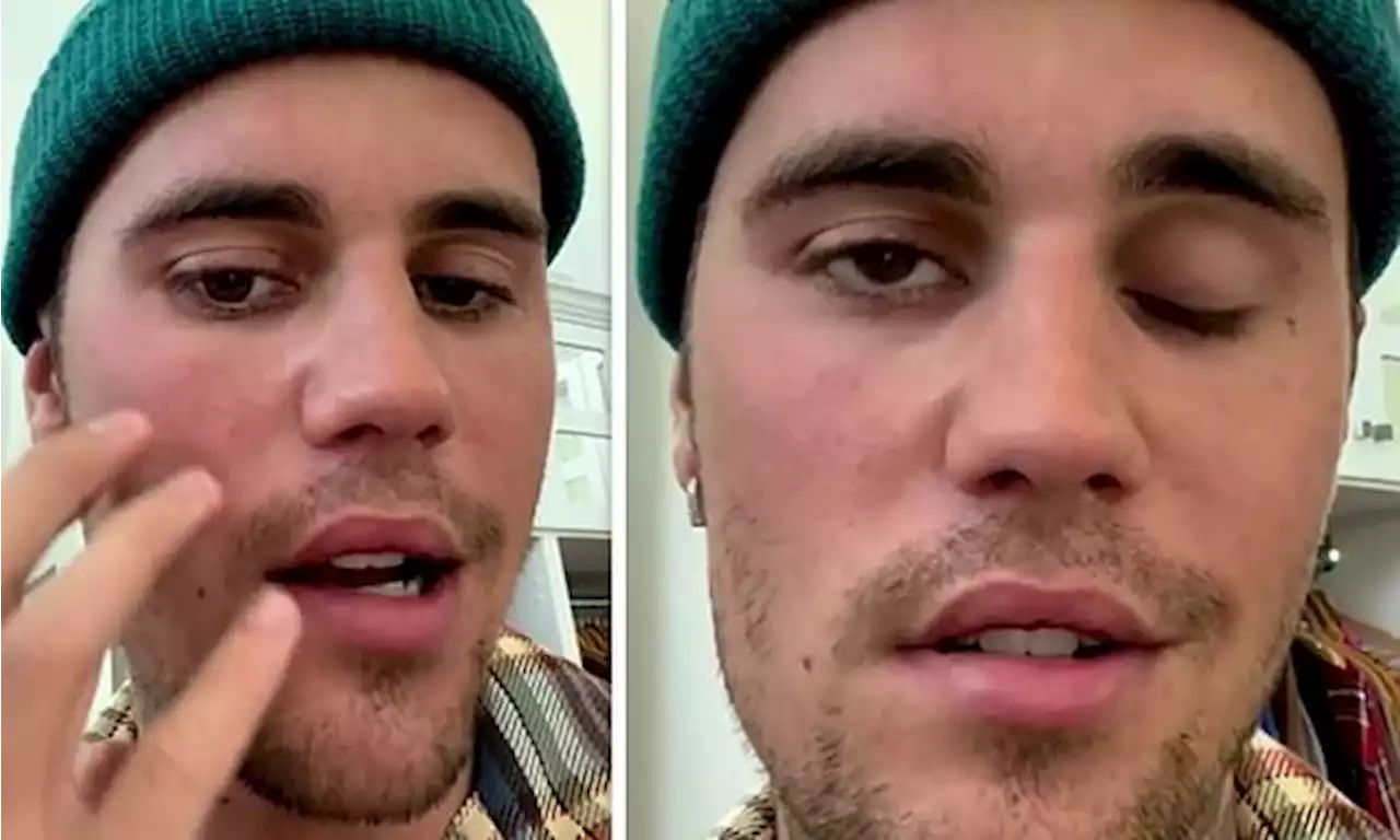 Justin Bieber reveals he has facial paralysis from RamsayHunt syndrome