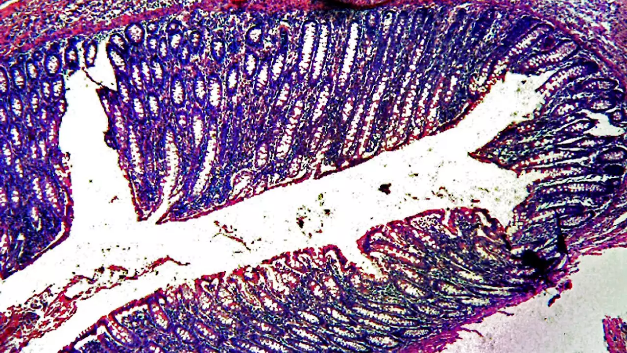 Medikament stoppt Darmkrebsvariante in Studie