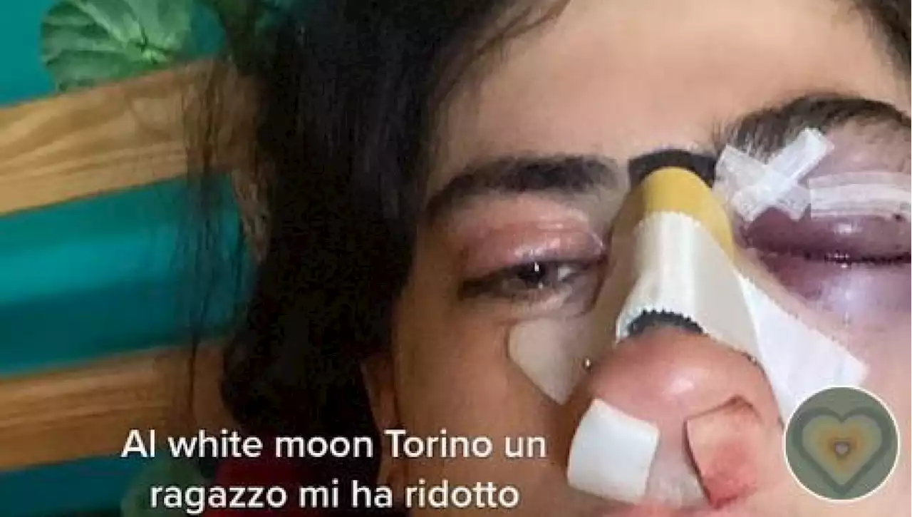 “In discoteca ho difeso il mio ragazzo e mi hanno colpita con un pugno in faccia”