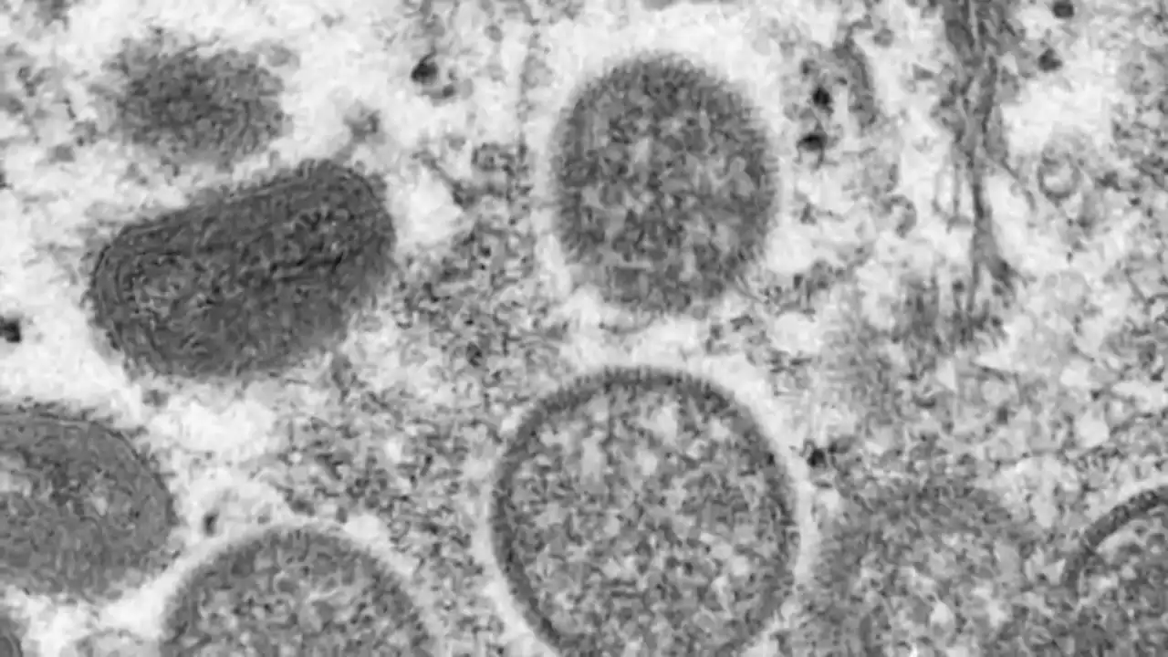 Mass. Health Officials Confirm 4th Monkeypox Case