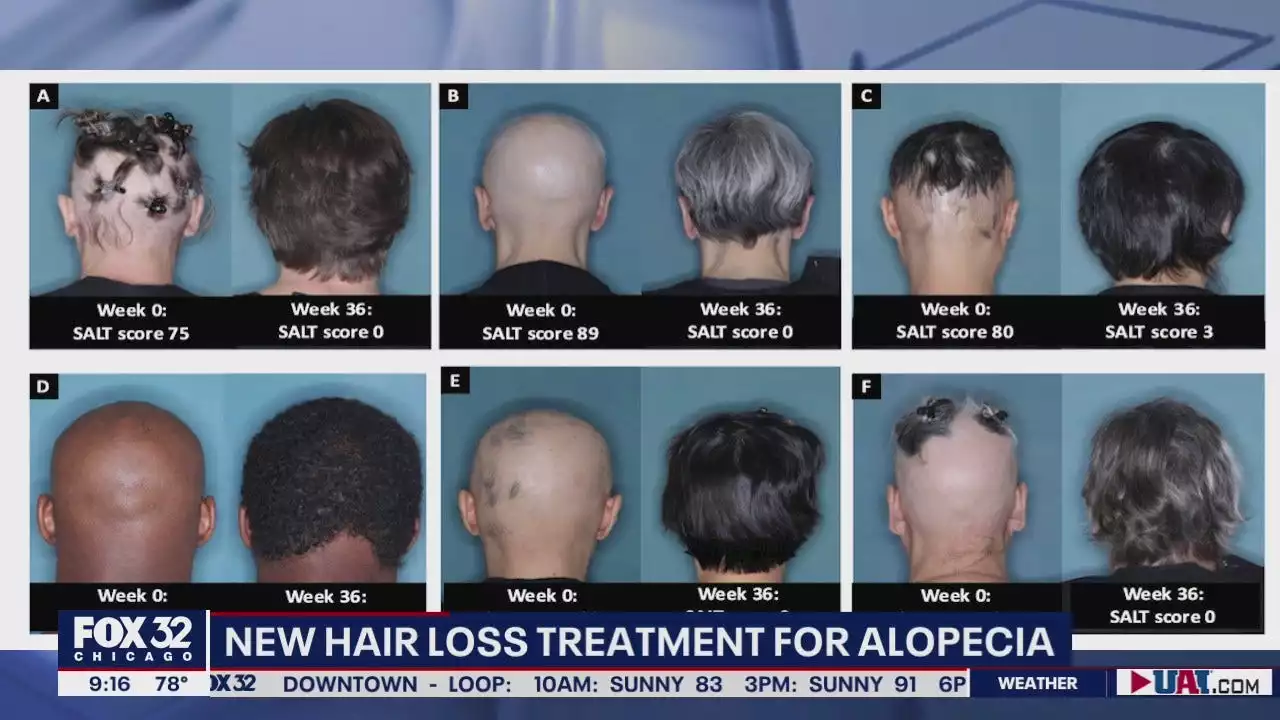 Breakthrough treatment for hair loss disorder shows promise