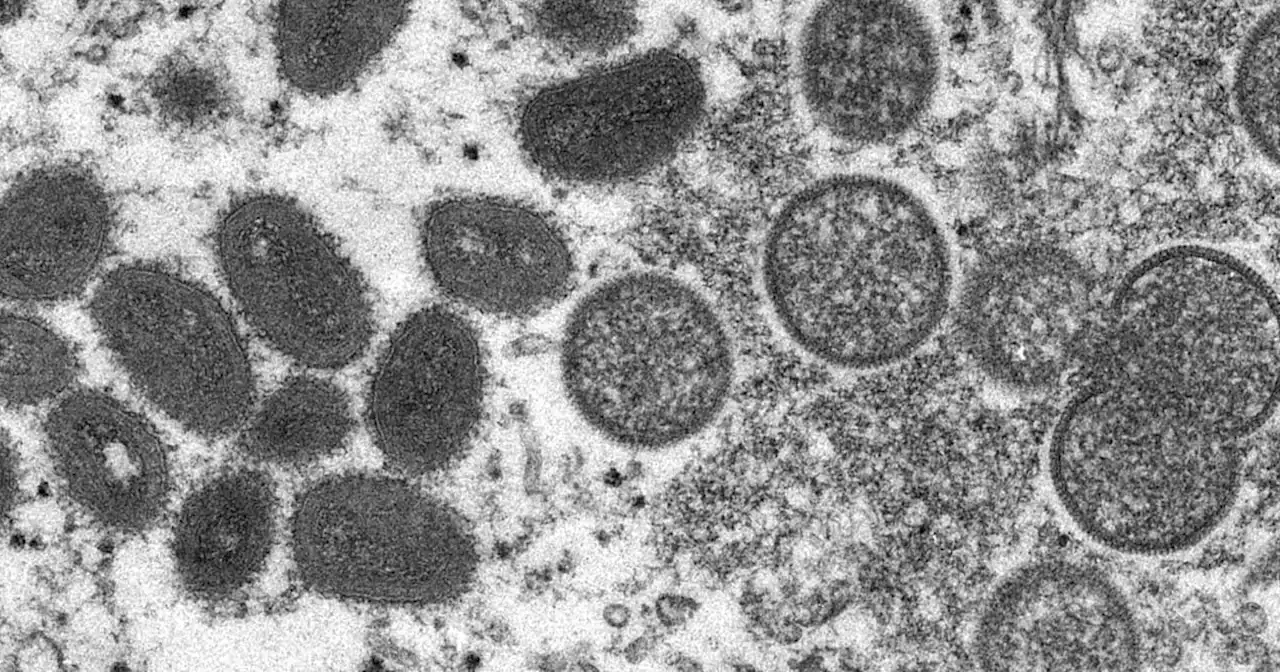 WHO looking into reports of monkeypox virus found in semen