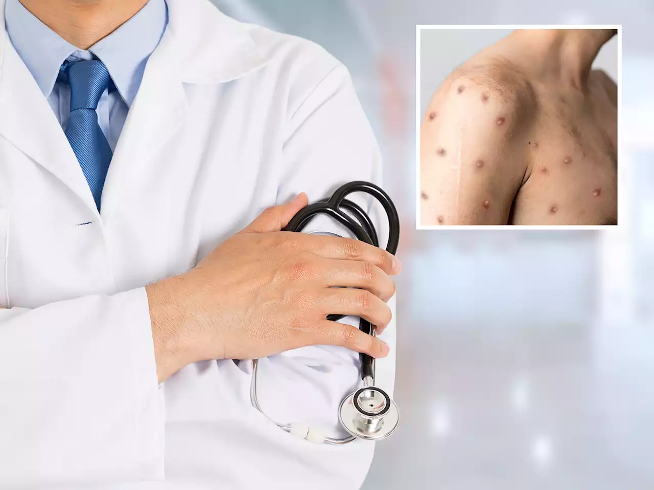 Gay doctor shares monkeypox experience: 'I was in disbelief'