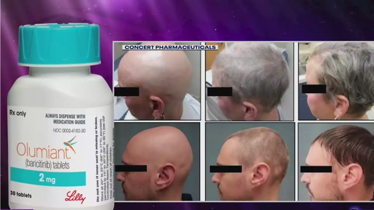 FDA approves landmark drug treatment for Alopecia