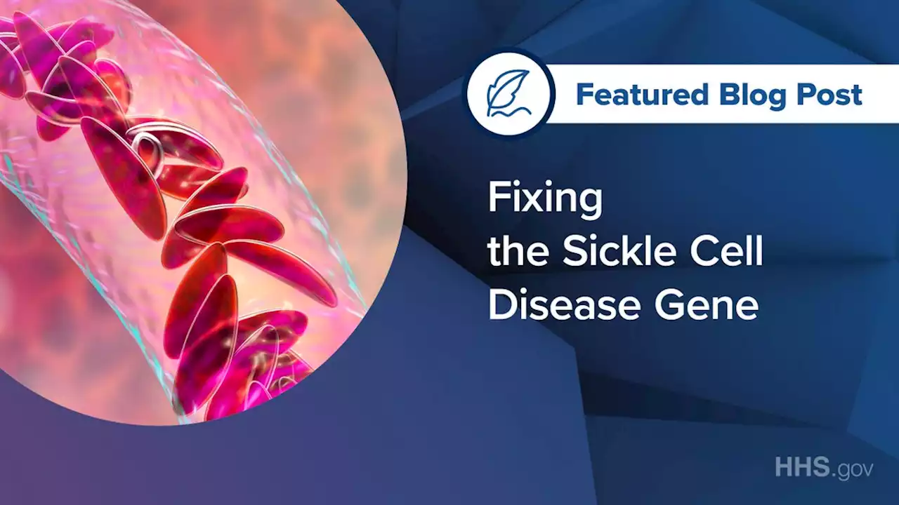 Fixing the sickle cell disease gene