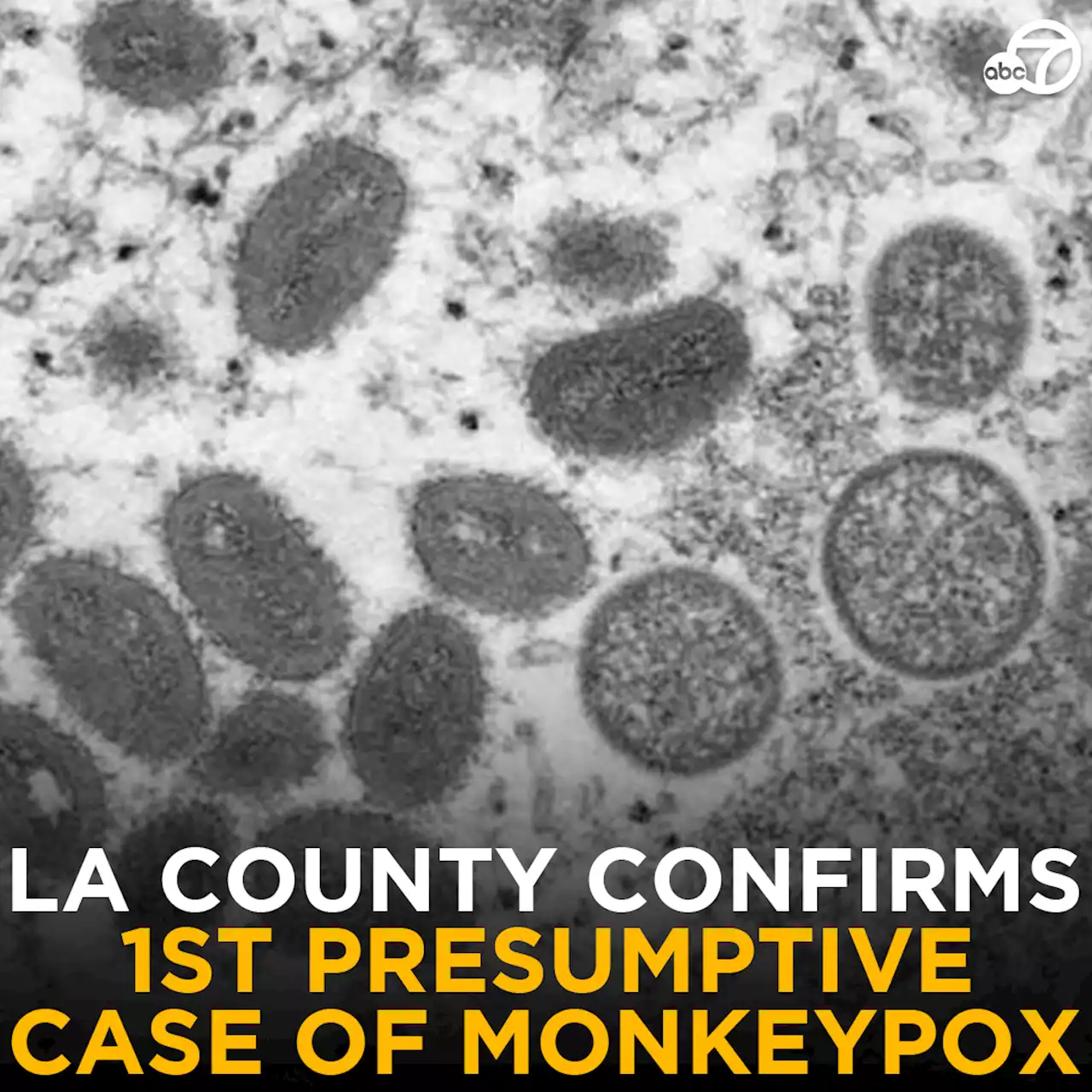 LA County confirms 1st presumptive case of monkeypox; final confirmation by CDC pending