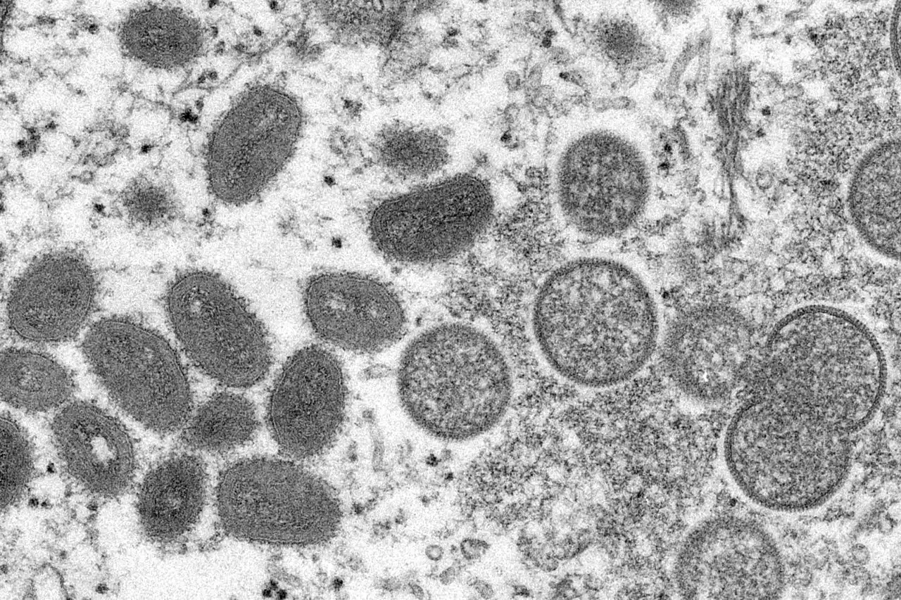 Georgia health officials confirm monkeypox case in Atlanta-area male