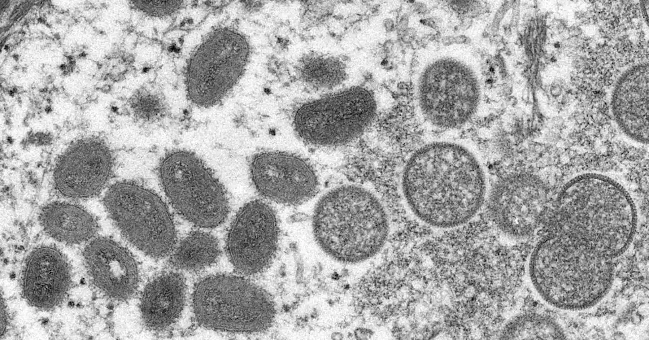 Los Angeles County confirms first presumptive case of monkeypox infection