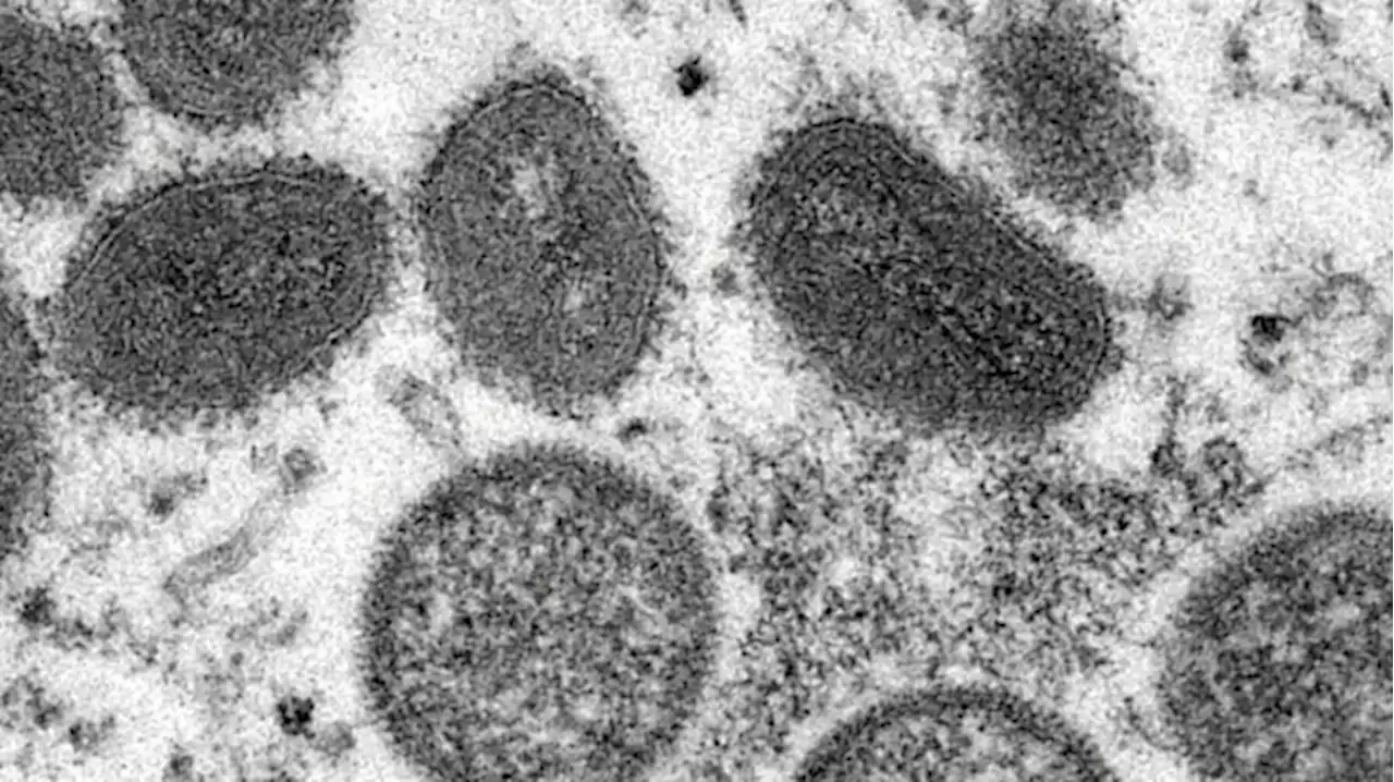 Monkeypox outbreak needs a united response, says WHO Africa