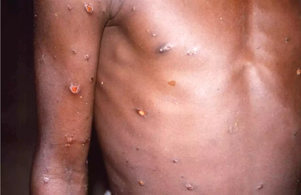 Africans see inequity in monkeypox response elsewhere