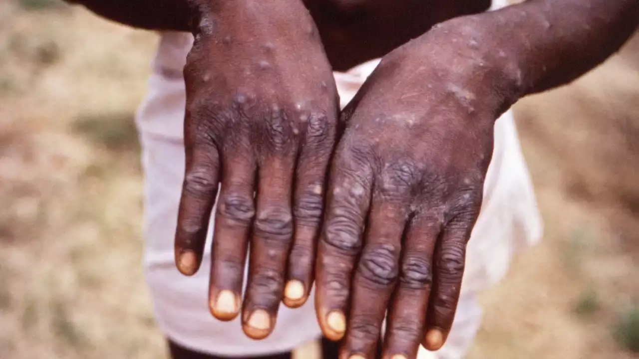 Second case of monkeypox identified in NSW