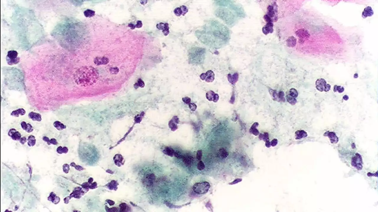 This 'unknown' STI is more common than gonorrhoea - with ethnically diverse women most affected