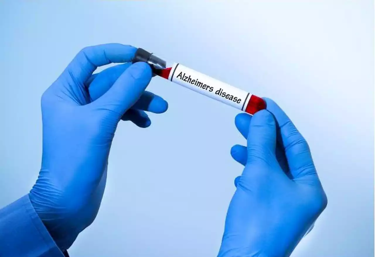 Is it Alzheimer’s? This revolutionary blood test gives doctors an easy way to tell.