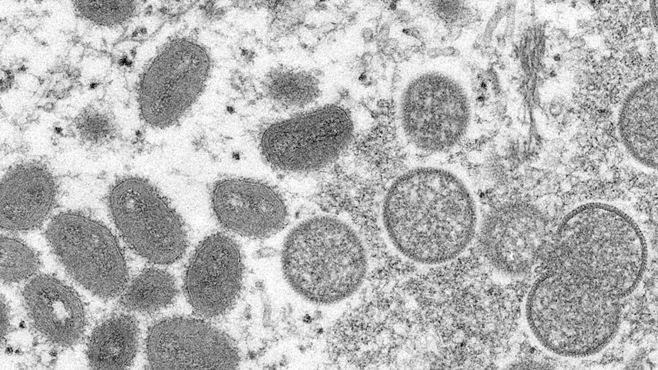 US aims to boost virus testing with 142 monkeypox cases confirmed