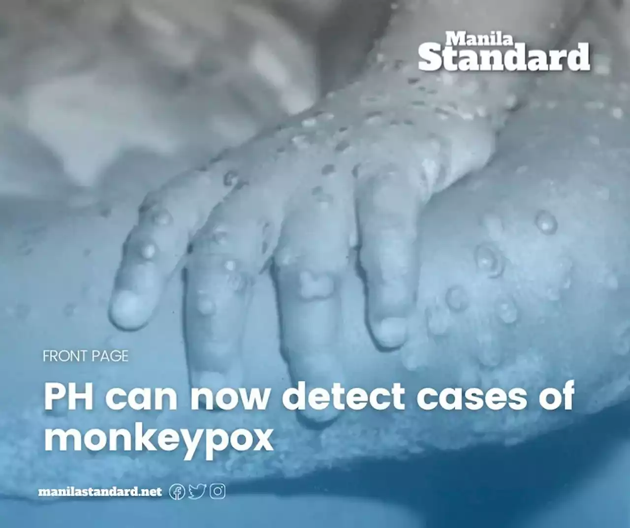 PH can now detect cases of monkeypox