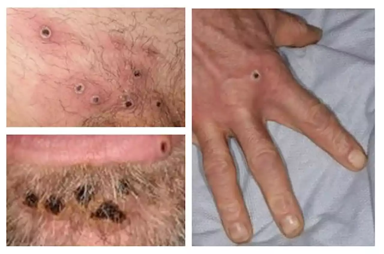 WHO emergency committee meets on monkeypox