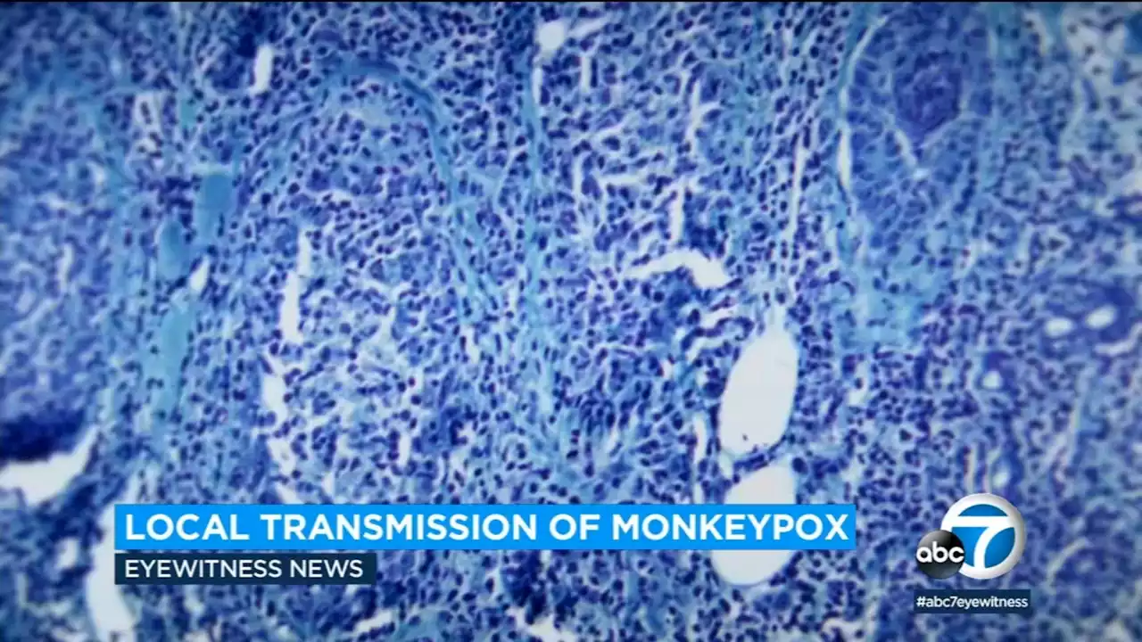 LA County reports local transmission of monkeypox; Recent 'large events' suspected