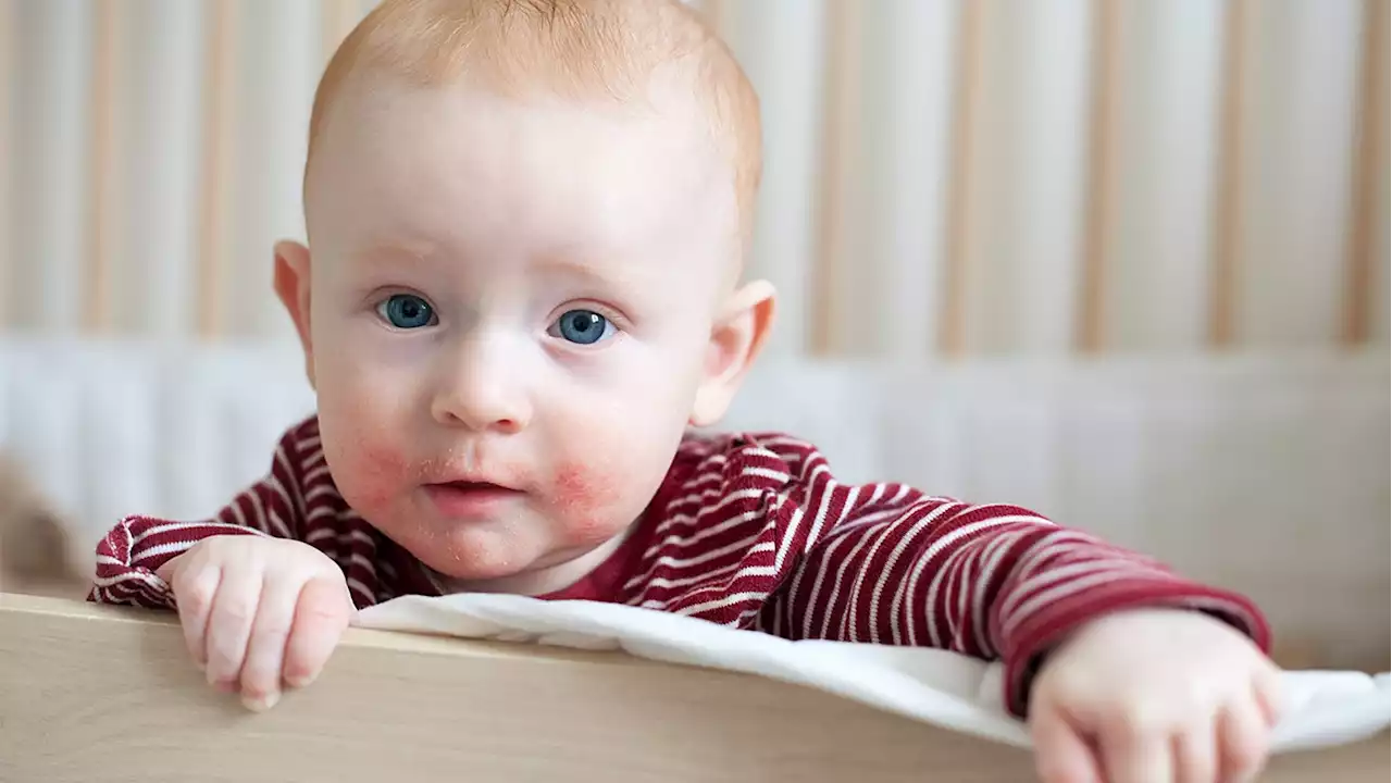 Everything you need to know about baby eczema