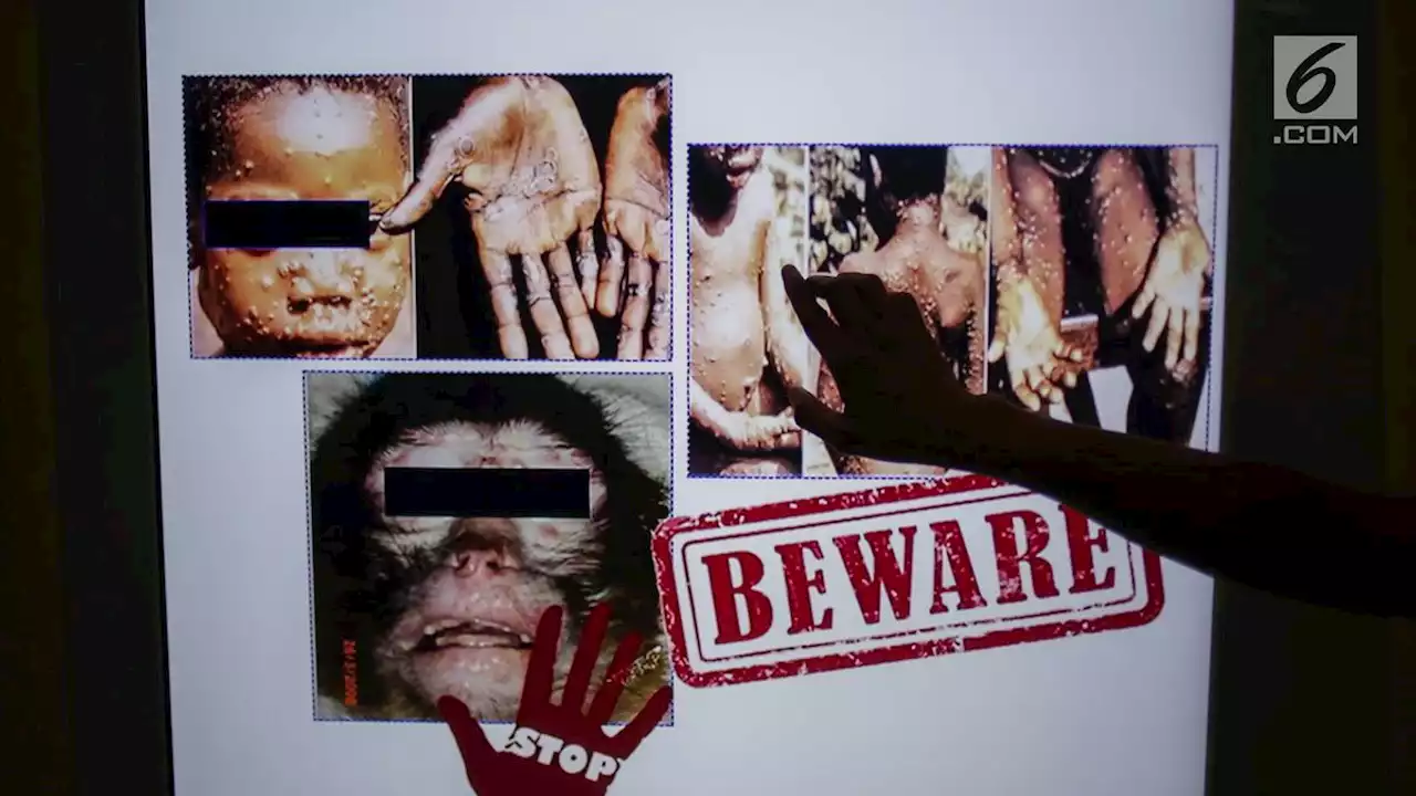 WHO: Wabah Cacar Monyet Monkeypox Bukan Darurat Kesehatan Masyarakat Dunia