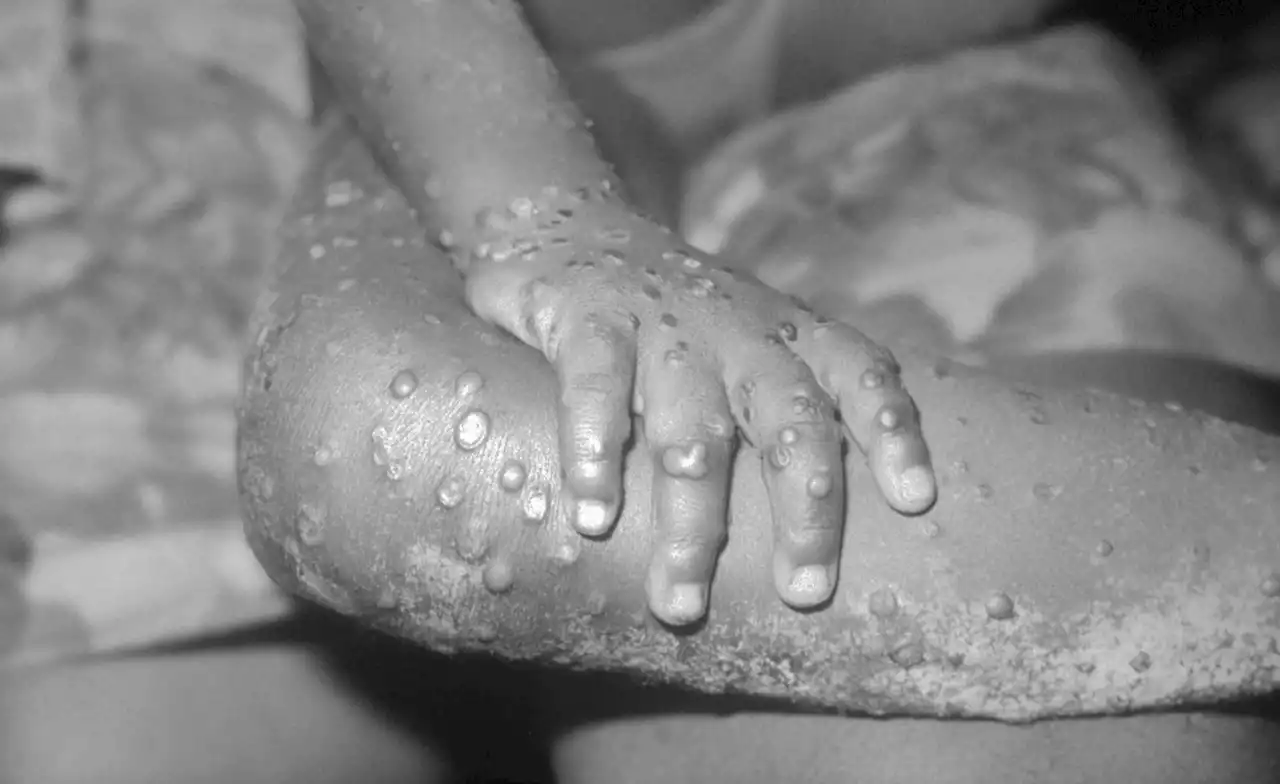 Nigeria: As Infections Spread, WHO Says Monkeypox Not Yet Global Health Emergency