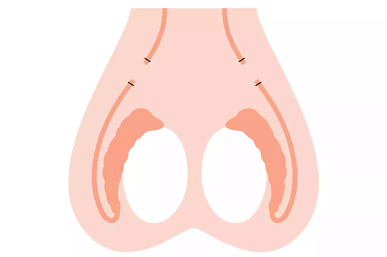 The Supreme Court Made These People Want To Get A Vasectomy